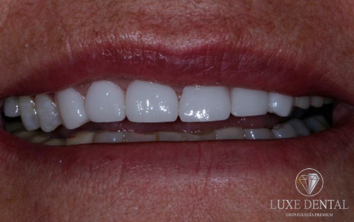 Resultado Alinear dientes