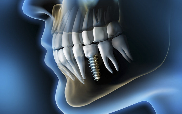 Implantología dental en nuestras clínicas de Coslada (Madrid) y Fuerteventura