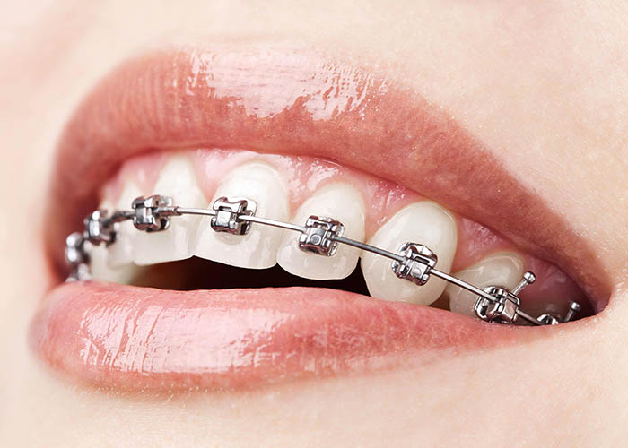 ¿Qué es la ortodoncia y para qué sirve?