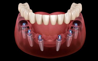 Implantes dentales All on 4 y All on 6