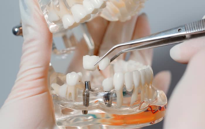 Colocación implante corona dental