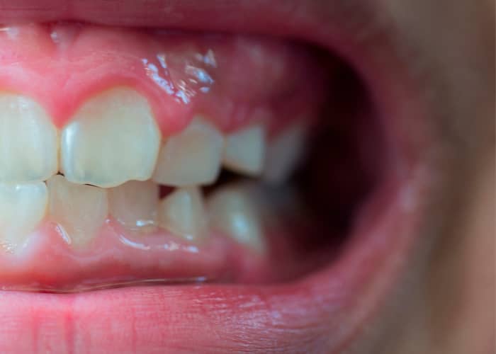 Agenesia dental. Cómo tratar la falta de un diente