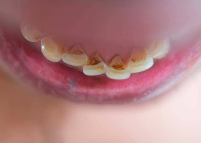 Eliminar y prevenir las manchas en los dientes