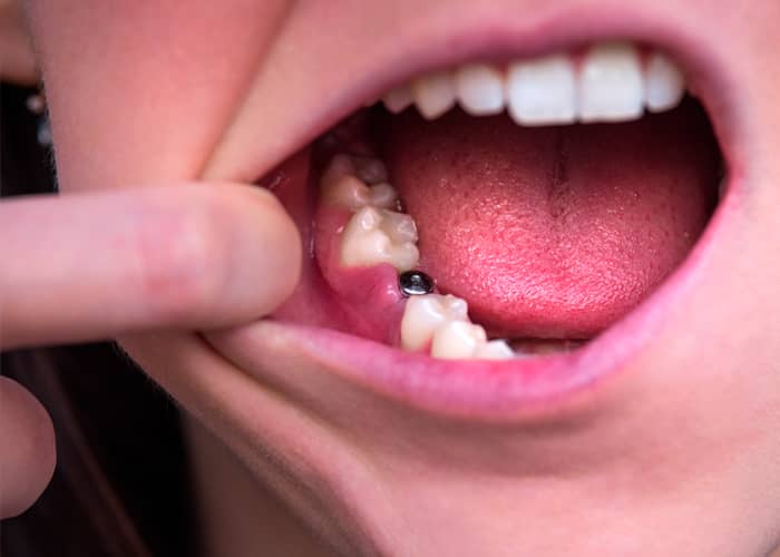 Motivos y Signos de rechazo de un implante dental