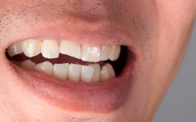 Fracturas dentales: qué son, tipos y tratamiento