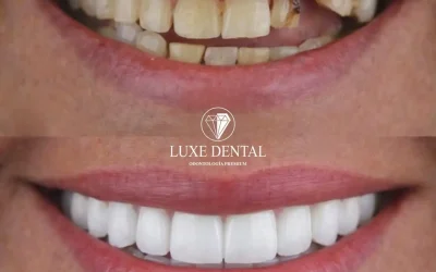 Carga inmediata de implantes: Dientes fijos en tan solo 12 horas