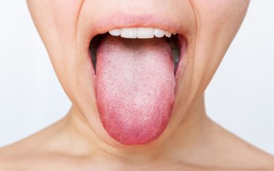 Lengua blanca: causas, tratamiento y diferencias con la candidiasis